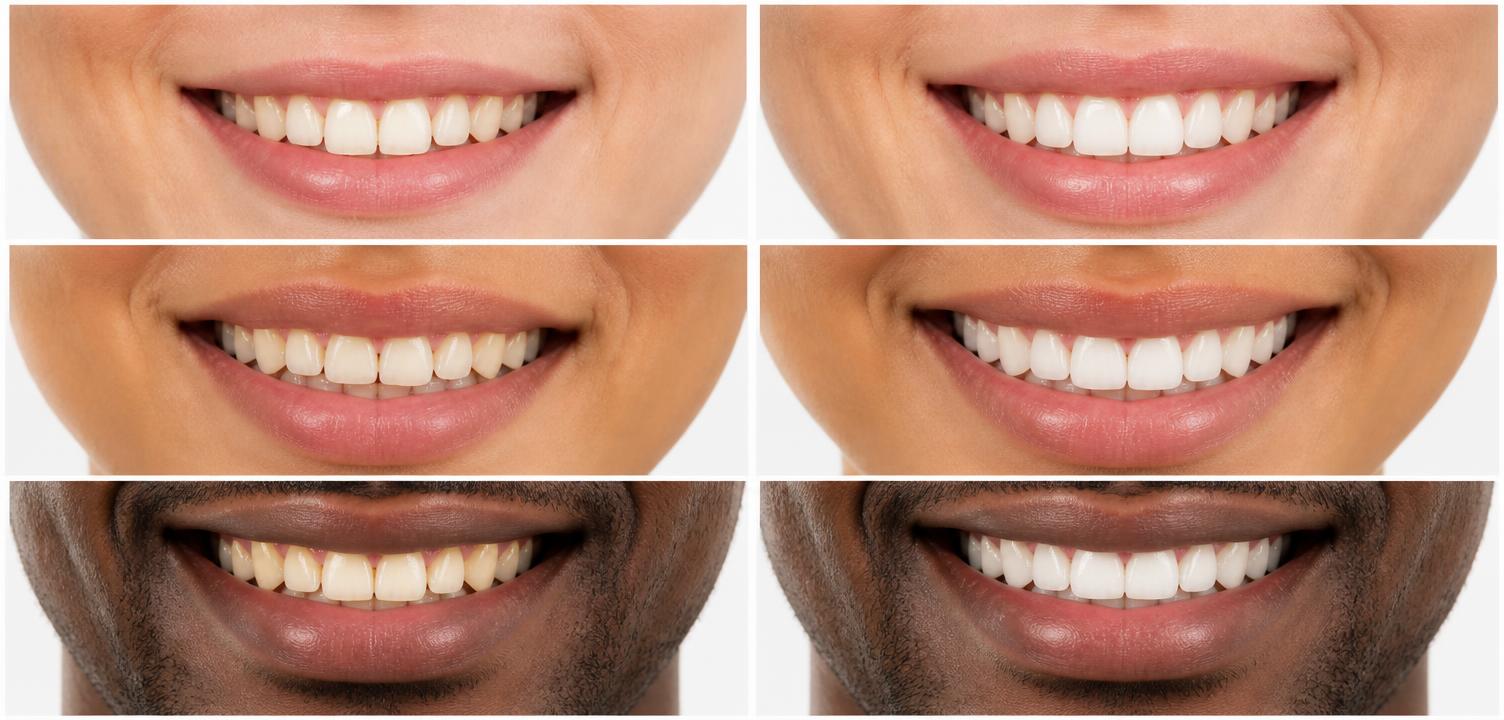 Three sample before and after smile transformation pairs